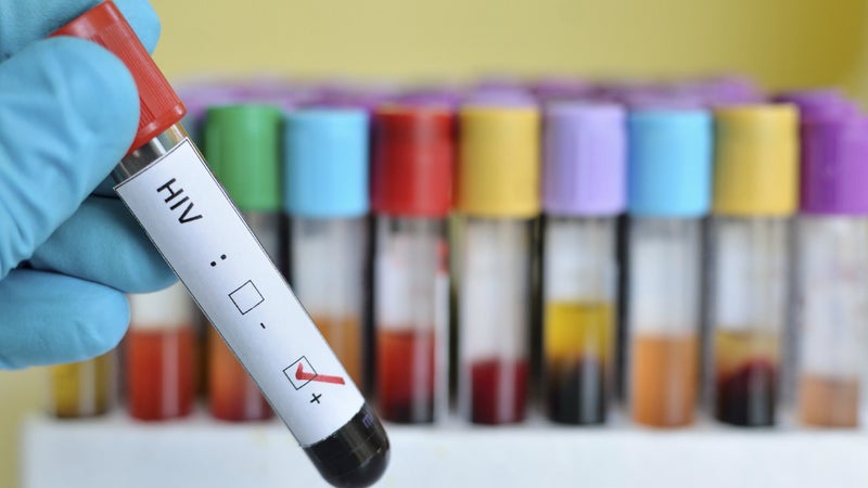 Un adulte sur 60 est porteur du virus: l'épidémie de sida déclarée "urgence nationale" aux îles Fidji