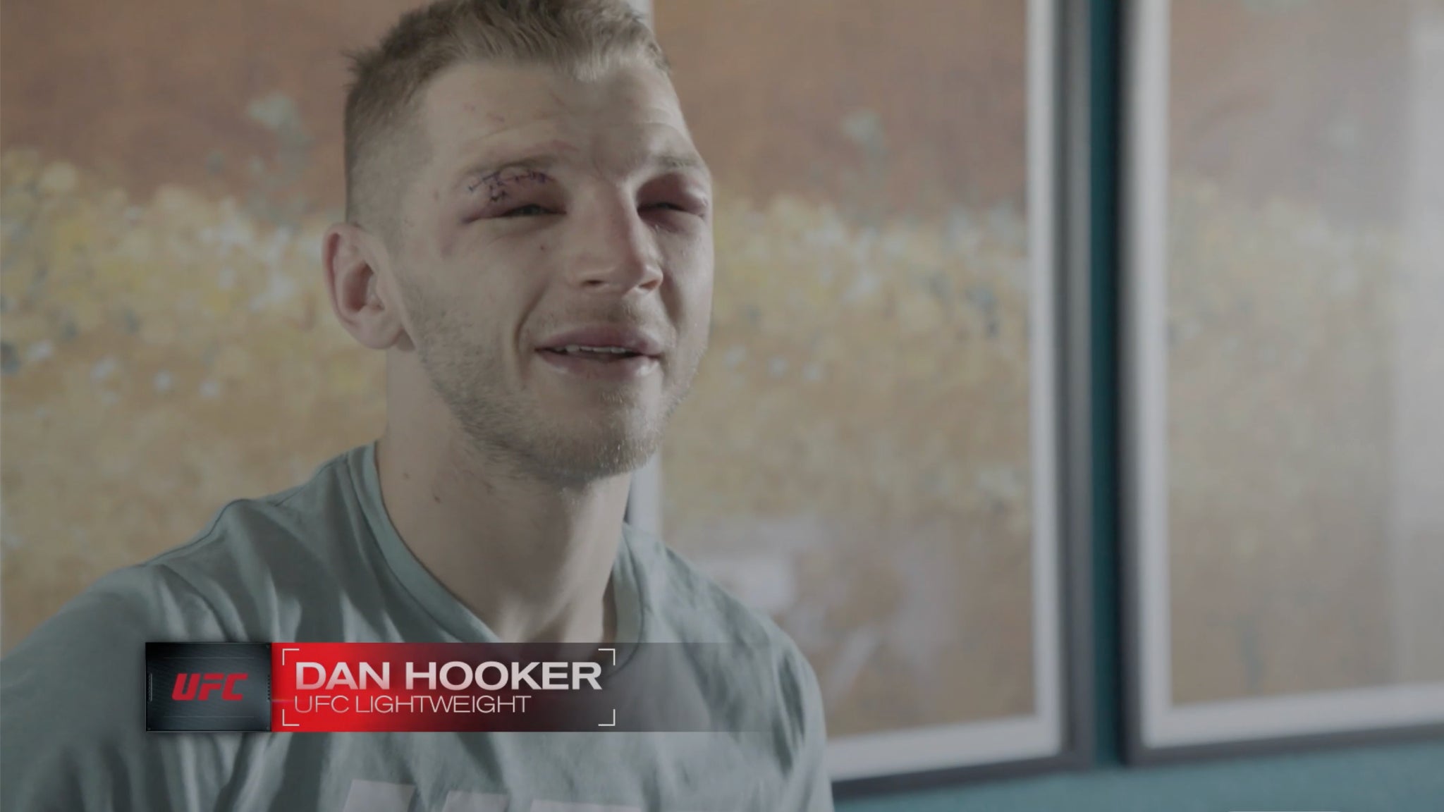 Το ακατάστατο πρόσωπο του Dan Hooker μετά τον αγώνα. Το ακατάστατο πρόσωπο του Dan Hooker μετά τον αγώνα.