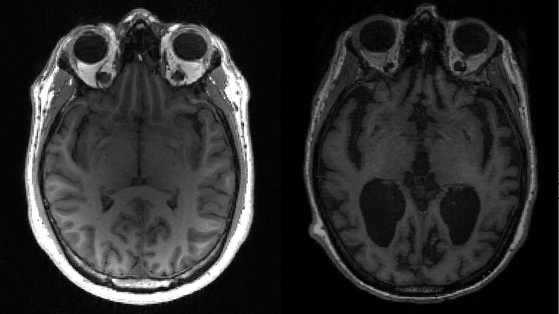 Alzheimer: IA, puces cérébrales... Ces innovations qui révolutionnent le dépistage et l'accompagnement