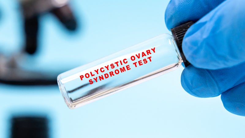 SOPK: pourquoi le syndrome des ovaires polykystiques change de nom pour devenir le SOMP
