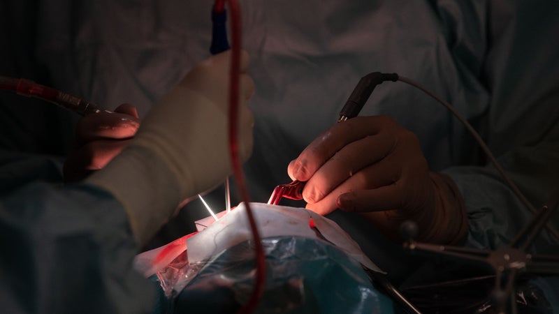 "Une erreur d’un millimètre peut faire toute la différence": pour la première fois, des neurochirurgiens londoniens ont retiré une tumeur au cerveau à l'aide de l'IA
